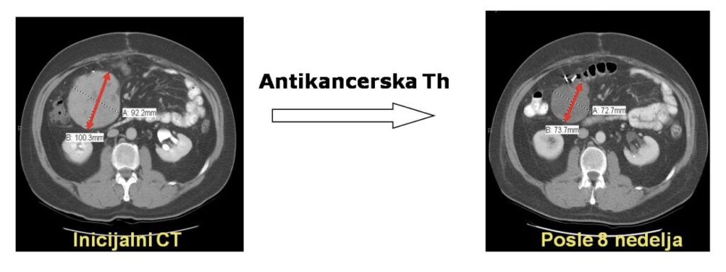 antikancerska terapija