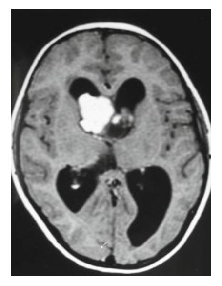 Primarni intraventrikularni tumor