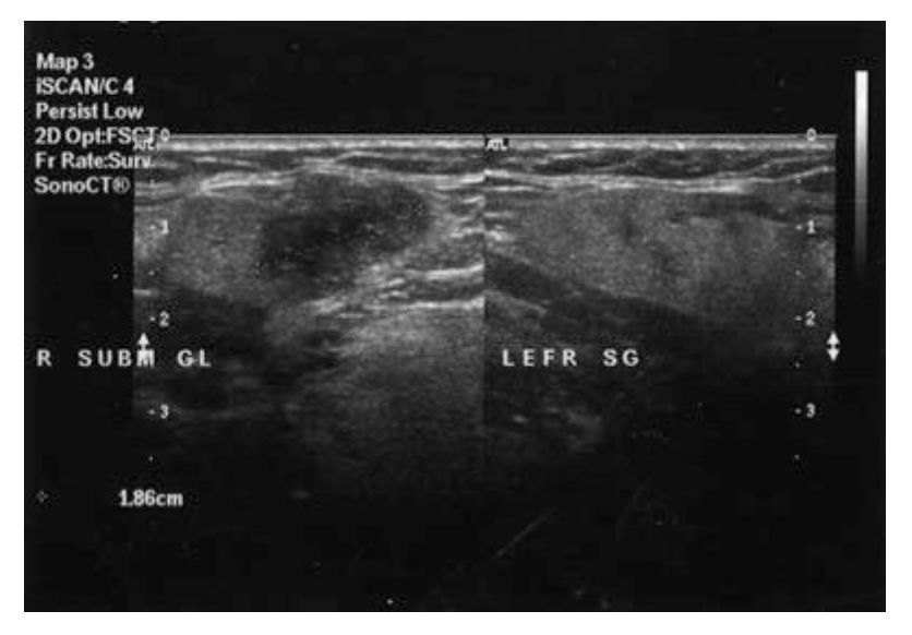 Epitelijalni tumor