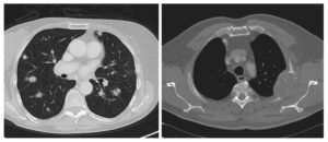 Melanom: Metastaza u CNS