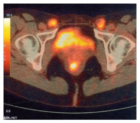 PET-CT karcinoma rektuma