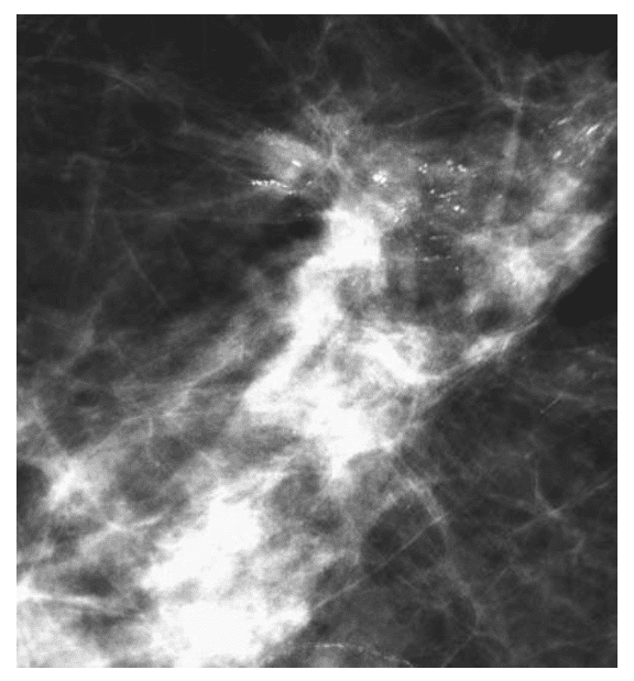 mikrokalcifikacije u tkivu dojke