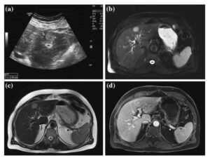 Hepatocelularni karcinom jetre