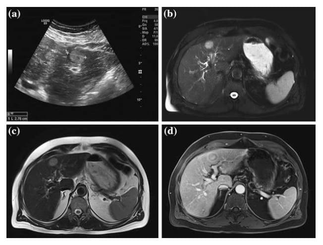 Hepatocelularni karcinom