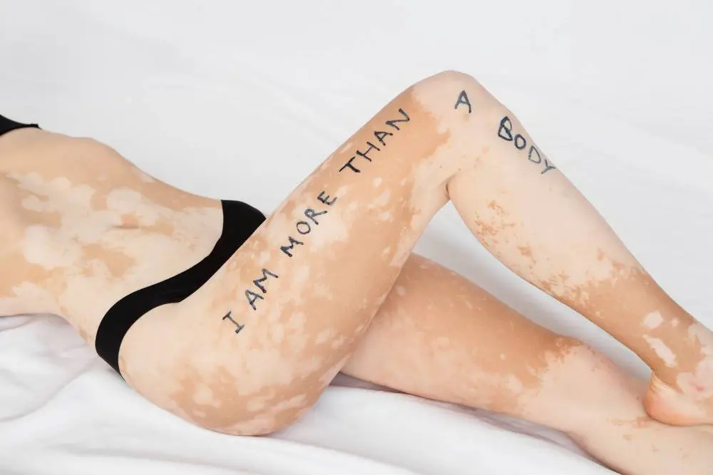 Vitiligo